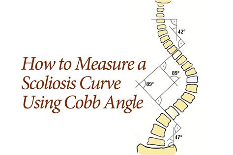 cobb angle for idiopathic scoliosis